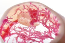 Impression 3D: Modèles pour la planification des interventions chirurgicales