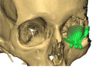L’impression 3D en santé : c’est à Lyon que ça se passe grâce à la plateforme commune d’impression CHU de Lyon (HCL)/Université Lyon 1