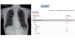 L'IA facilite l'interprétation des radiographies du thorax réalisées pour les urgentistes. ©Incept