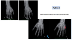 La même plateforme est utilisée pour détecter également les fractures des membres inférieurs et supérieurs. ©AZMed
