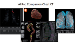 Détection automatique des lésions pulmonaires et segmentation du cœur, de l'aorte thoracique, des vertèbres dorsales et des poumons. ©Siemens