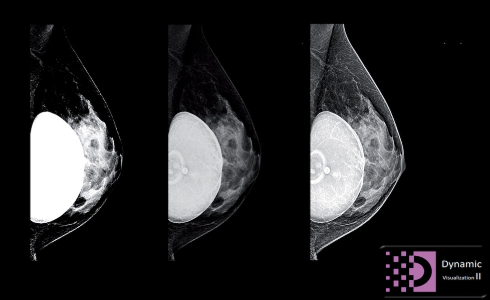 DYN II : analyse intelligente des structures du sein au service de la dynamique de l’image, pour un diagnostic facilité. ©DR