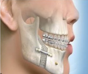 Chaîne numérique de planification des cas de chirurgie orthognatique. Chaîne numérique de planification des cas de chirurgie orthognatique.