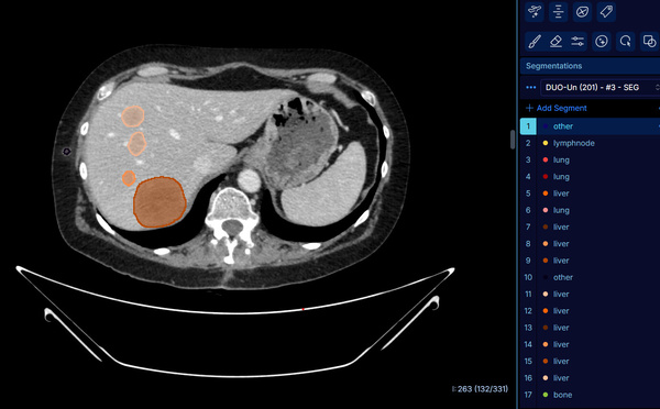À Gustave Roussy, un nouvel outil d'IA au service d'une détection optimale du cancer par imagerie