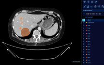 À Gustave Roussy, un nouvel outil d'IA au service d'une détection optimale du cancer par imagerie